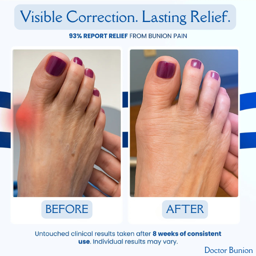 Doctor Bunion Corrector